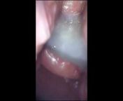 After the creampie, play with semen that flowed from vagina from uterus duplex and vagina duplex vaginoscopy hysteroscopy