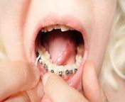 2nd day in braces - dental floss - close up mouth tour from manju sunichen braww xxx clip